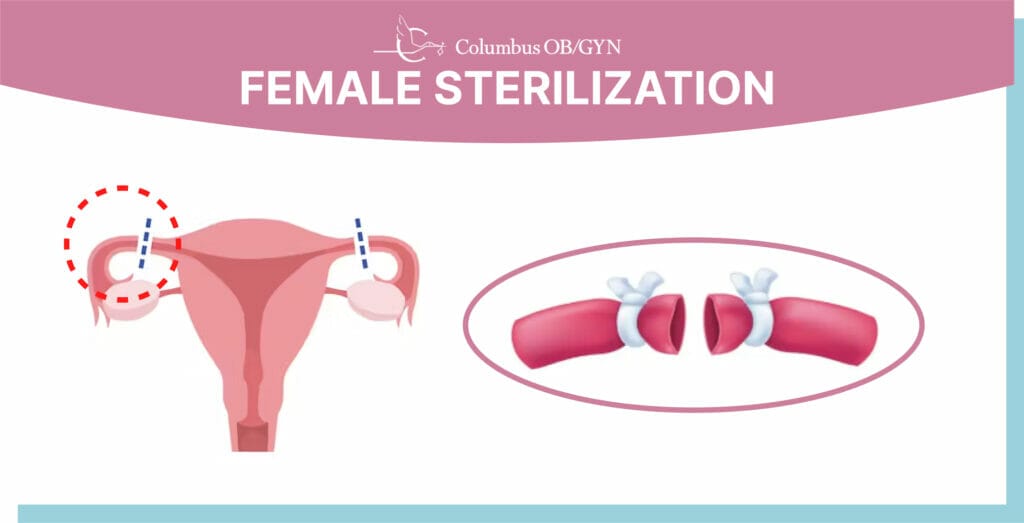 Illustration representing a medical concept of female organ sterilization, depicting an abstract and simplified representation of the female reproductive system.