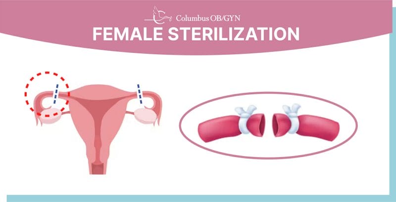 female sterilization