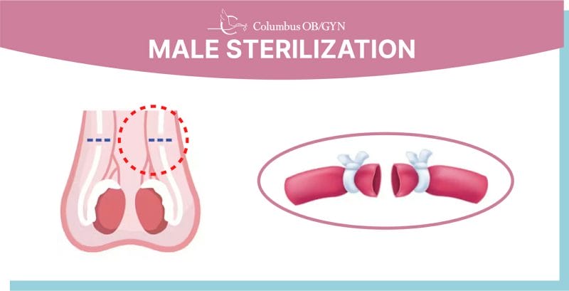Illustration representing a medical concept of male organ sterilization, showing a simplified, abstract depiction of the male reproductive system